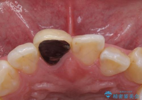 前歯の色が気になる。オールセラミッククラウンでのやり替えの治療前