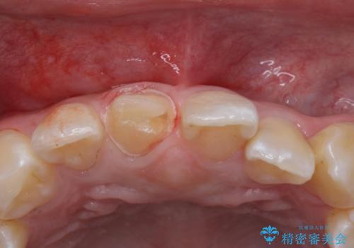 前歯の色が気になる。オールセラミッククラウンでのやり替えの治療中