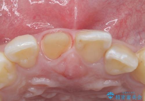 前歯の色が気になる。オールセラミッククラウンでのやり替えの治療中