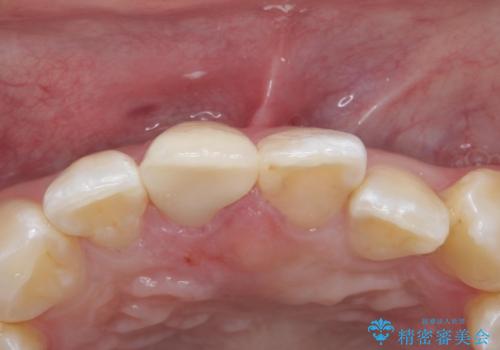 前歯の色が気になる。オールセラミッククラウンでのやり替えの治療後