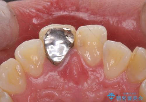 前歯の色が気になる。オールセラミッククラウンでのやり替えの治療前