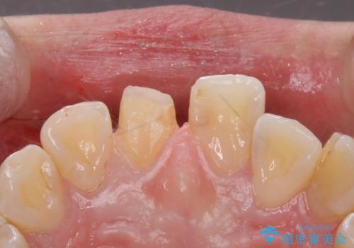 前歯の色が気になる。オールセラミッククラウンでのやり替えの治療中