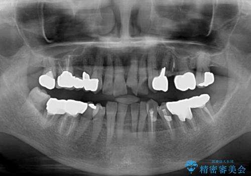 長年気になっていた前歯 矯正治療と補綴治療による審美歯科治療の治療前