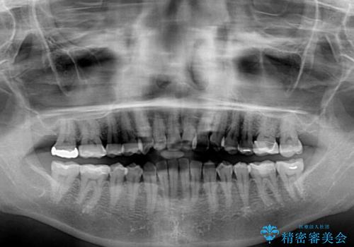 クロスバイトを治したい インビザラインによる矯正治療の治療前