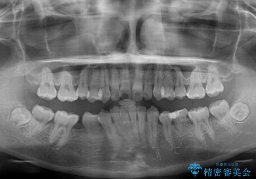 欠損や残存乳歯、深い咬み合わせ ワイヤー矯正で咬合改善の治療前