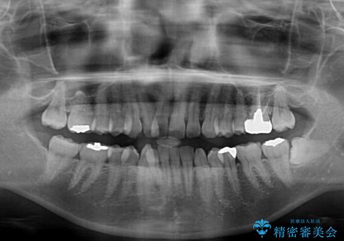 【モニター】閉じにくい前歯とクロスバイト ワイヤー装置での抜歯矯正の治療前