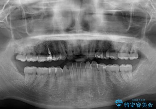 左右に顎がずれた咬み合わせ ワイヤー矯正で咬み合わせを改善の治療前