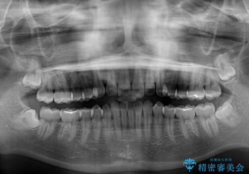 気になる前歯と咬み合わせを改善 インビザライン・モデレートの治療前