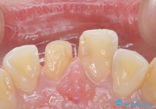 前歯の色が気になる。オールセラミッククラウンでのやり替えの治療中