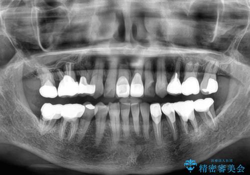 長年気になっていた前歯 矯正治療と補綴治療による審美歯科治療の治療後