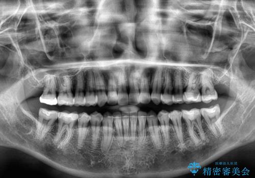 クロスバイトを治したい　インビザラインによる矯正治療の治療後