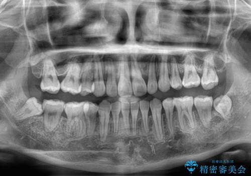 欠損や残存乳歯、深い咬み合わせ　ワイヤー矯正で咬合改善の治療後