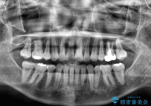 【モニター】閉じにくい前歯とクロスバイト ワイヤー装置での抜歯矯正の治療後