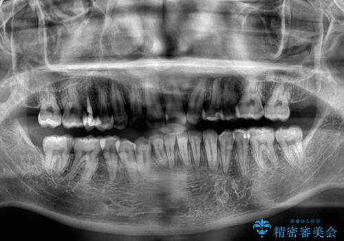 左右に顎がずれた咬み合わせ　ワイヤー矯正で咬み合わせを改善の治療後