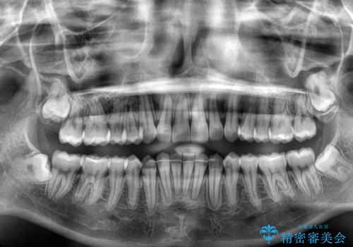 気になる前歯と咬み合わせを改善　インビザライン・モデレートの治療後