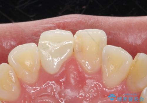 前歯の色が気になる。オールセラミッククラウンでのやり替えの治療後