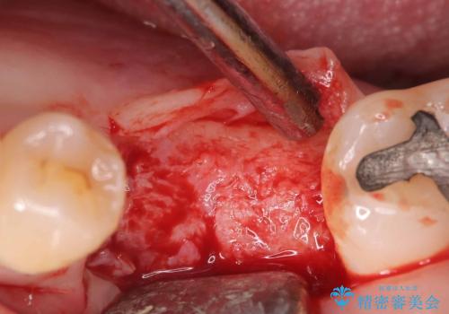 根尖性歯周炎|分岐部病変|パーフォレーション|インプラントで治療の治療中