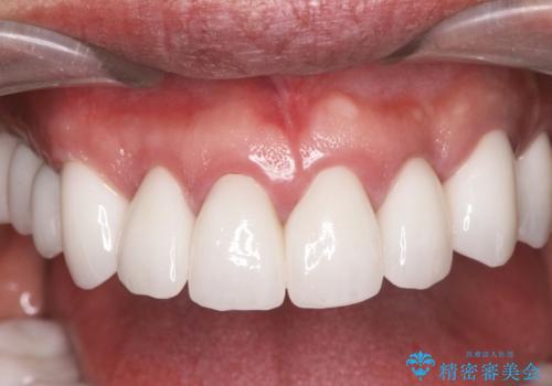 [ 歯周外科手術 ]  セラミック治療後の歯ぐきの違和感の治療後