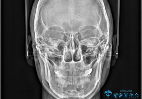 正中離開・クロスバイト・すきっ歯・叢生|インビザラインで治療の治療後