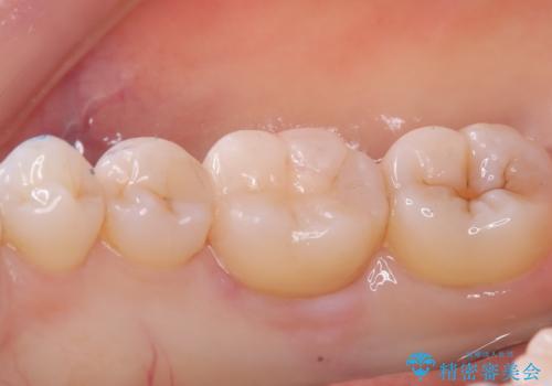 【セラミックインレー】歯がたまーにしみるの治療後