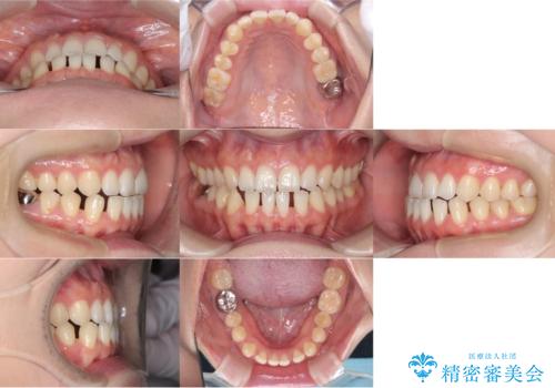 すきっ歯・切端咬合・空隙歯列|インビザラインで11ヵ月で治療完了の治療前