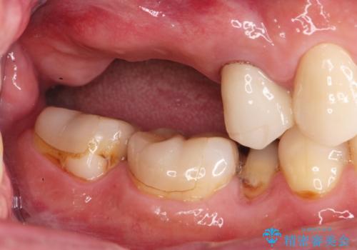 奥歯でしっかりと咬みたい 咬合機能をしっかりと回復するインプラント治療の治療前