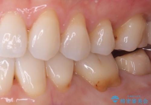 【セラミッククラウン】【生活歯髄療法】歯に穴が空いているの治療中