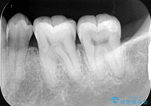 【セラミッククラウン】【生活歯髄療法】歯に穴が空いているの治療前