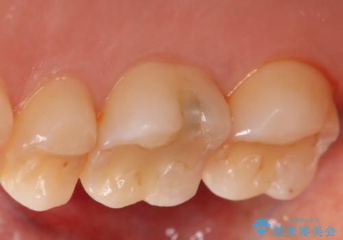 虫歯をしっかり治したい セラミックインレーの治療前
