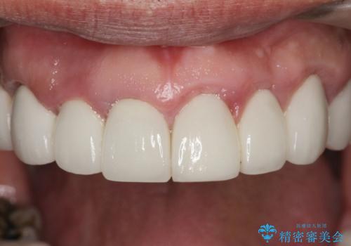 [ 歯周外科手術 ]  セラミック治療後の歯ぐきの違和感の治療前