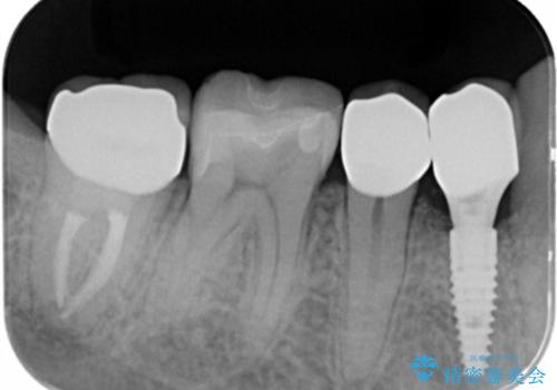 すべての虫歯治療をしたいの治療後