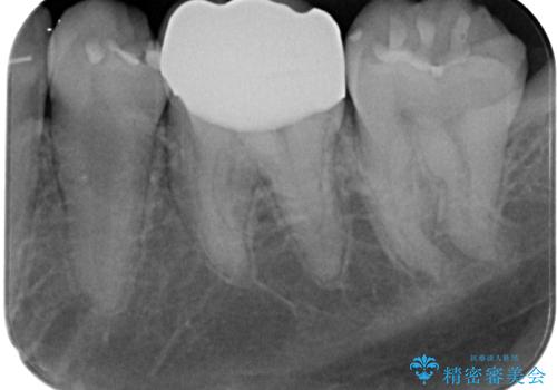 左下が虫歯になっている気がする オールセラミッククラウンの治療後