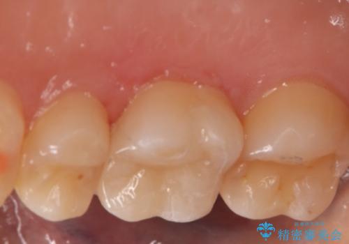 虫歯をしっかり治したい セラミックインレーの治療後