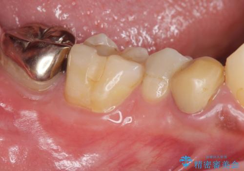 すべての虫歯治療をしたいの症例 治療前