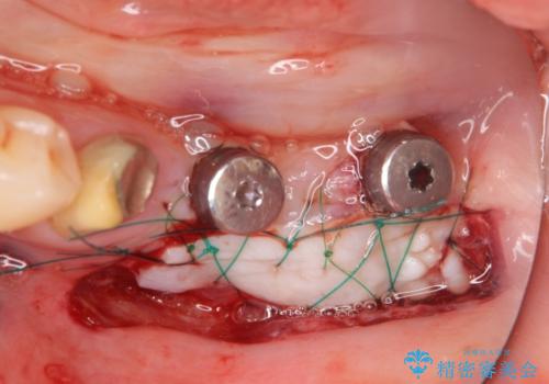 遊離歯肉移植術を併用した、破折歯のインプラント治療の治療中