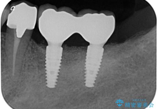 遊離歯肉移植術を併用した、破折歯のインプラント治療の治療後