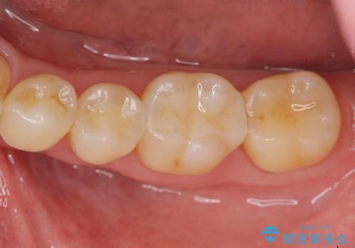 銀歯を外してのセラミック治療の症例 治療後