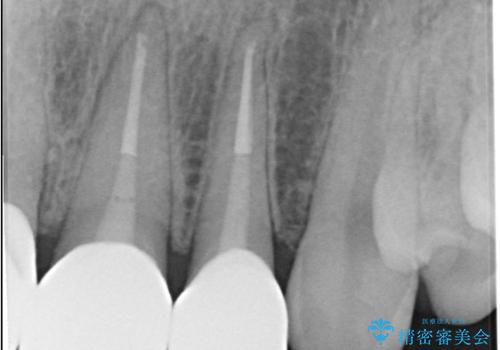 欠けて変色した前歯を一新!オールセラミックで叶える自然な笑顔の治療後