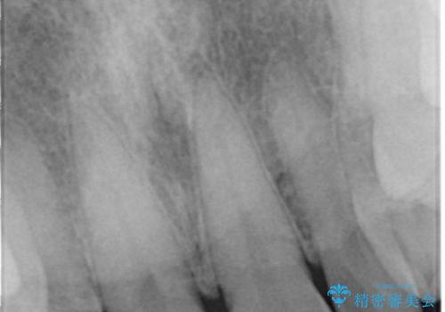前歯が欠けたので綺麗にしたい オールセラミッククラウンの治療前