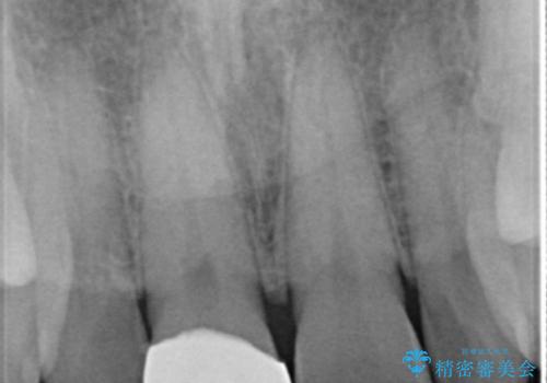前歯が欠けたので綺麗にしたい オールセラミッククラウンの治療後