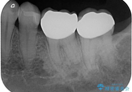 話すときに銀歯が見えて気になる セラミックでキレイに治す!の治療後