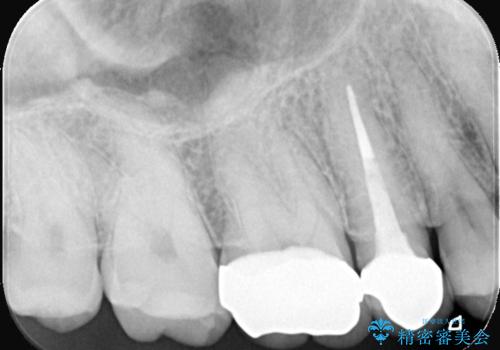 奥歯の銀歯を美しく一新!歯の破折を防ぐセラミッククラウンの治療後