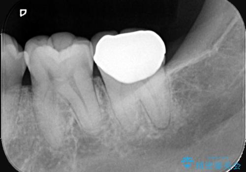 【セラミッククラウン】【生活歯髄療法】歯に穴が空いているの治療後