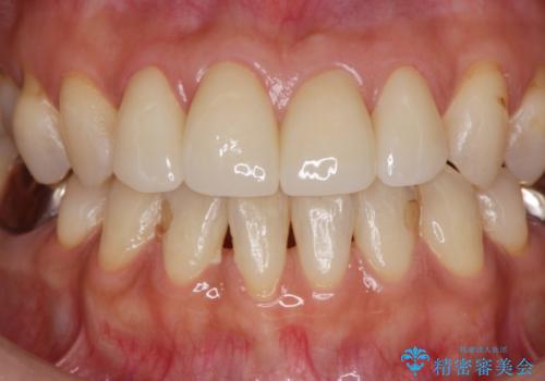 前歯の劣化したコンポジットレジン修復をセラミッククラウンへの治療後