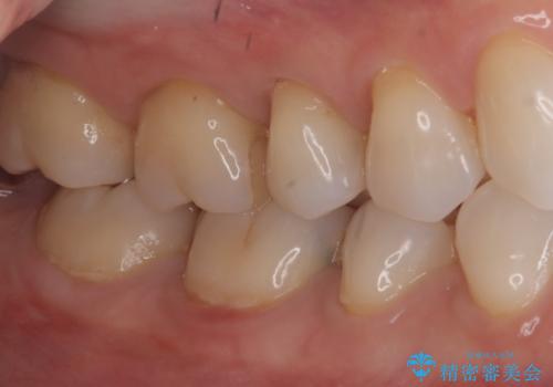 【セラミックインレー】歯がたまーにしみるの治療前