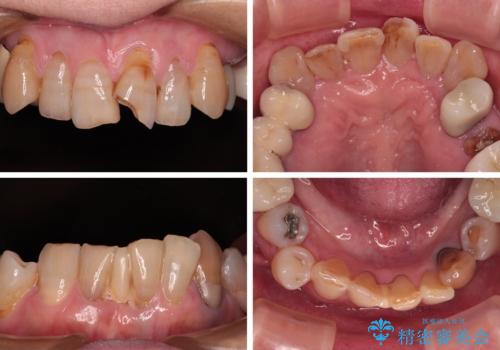 長年気になっていた前歯 矯正治療と補綴治療による審美歯科治療の治療前