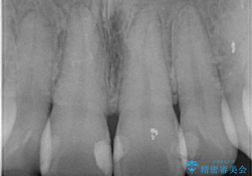 前歯の劣化したコンポジットレジン修復をセラミッククラウンへの治療前