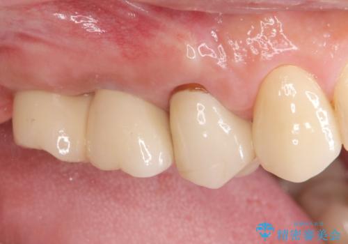 奥歯でしっかりと咬みたい　咬合機能をしっかりと回復するインプラント治療の症例 治療後