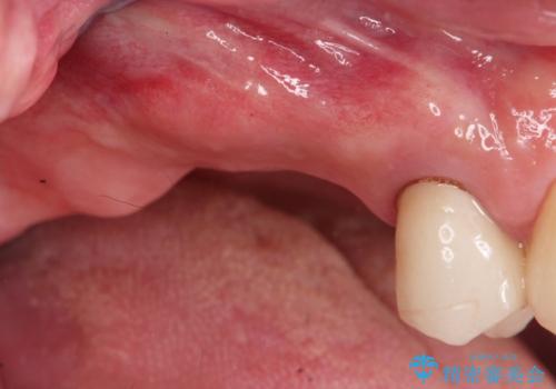 奥歯でしっかりと咬みたい　咬合機能をしっかりと回復するインプラント治療の症例 治療前