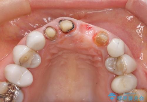 [ セラミック治療 ]  歯ぐきの際の黒ずみを改善したいの治療中